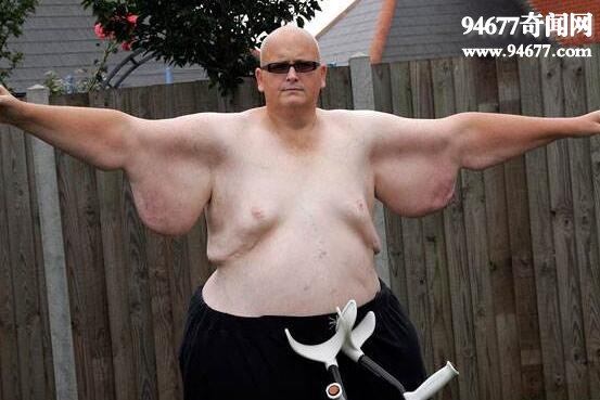 半吨人保罗·马森减肥成功，曾是世界上最胖的人