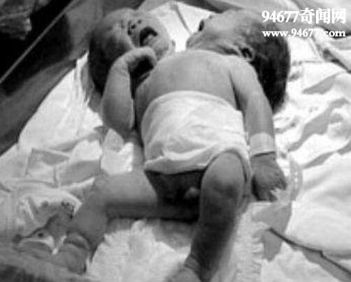 巴西双头婴儿诞生，两个头颅共用一个身体
