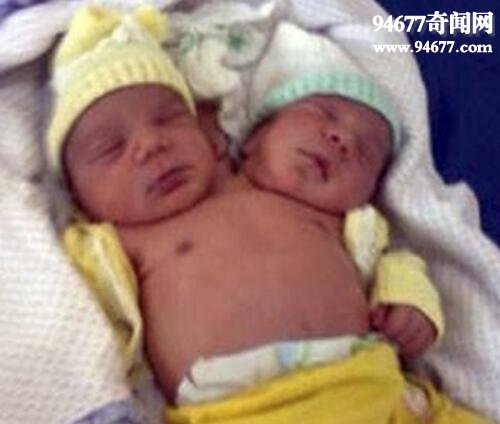 巴西双头婴儿诞生，两个头颅共用一个身体