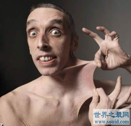 世界上皮肤最有弹性的人，任意拉扯皮肤，长度达到15.8厘米(www.gifqq.com)