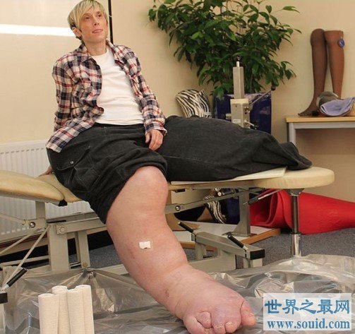 世界上最大最粗的腿，两腿达到了108公斤(www.gifqq.com)