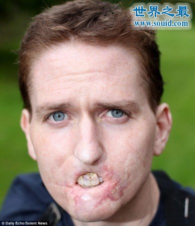 世界上没有嘴唇的男人，被细菌吃掉(重口味)(www.gifqq.com)