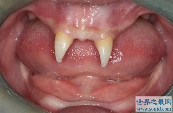 盘点世界上十大最奇怪的牙齿，重口味慎入(www.gifqq.com)