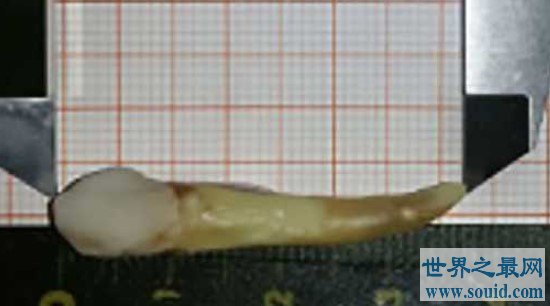 世界上最长的牙齿，拔下来后发现长达3.67厘米(www.gifqq.com)