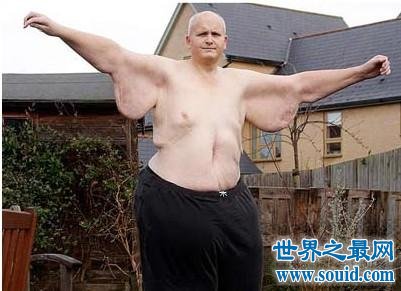 世界上最胖的人——保罗·马森，减完肥后还剩那么多肉(www.gifqq.com)