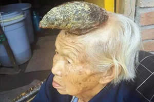 中国87岁老太头上长出牛角，太恐怖